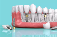 Имплантация зубов