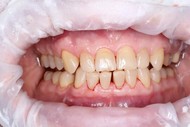 Ультразвуковая чистка зубов (снятие твердых зубных отложений)